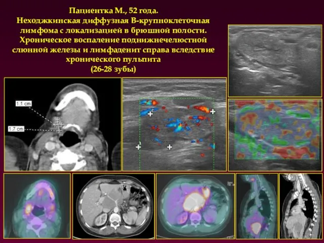 Пациентка М., 52 года. Неходжкинская диффузная В-крупноклеточная лимфома с локализацией в