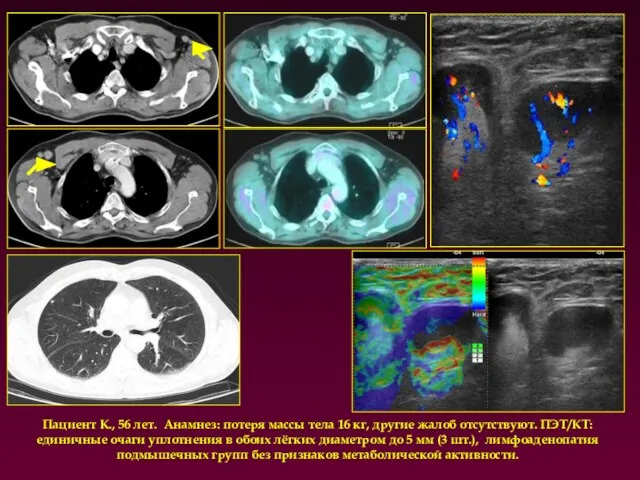 Пациент К., 56 лет. Анамнез: потеря массы тела 16 кг, другие