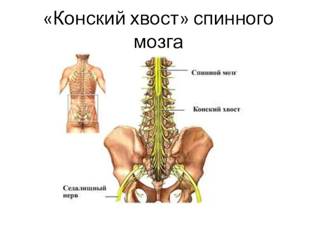 «Конский хвост» спинного мозга