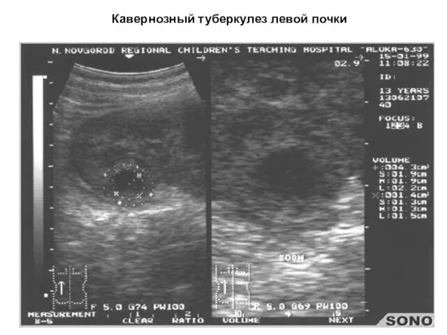 Кавернозный туберкулез левой почки