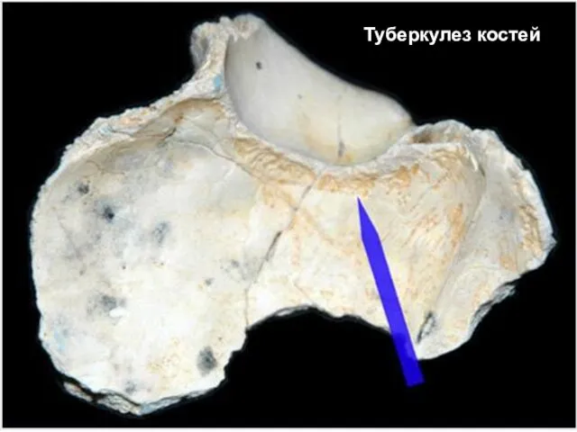 Туберкулез костей