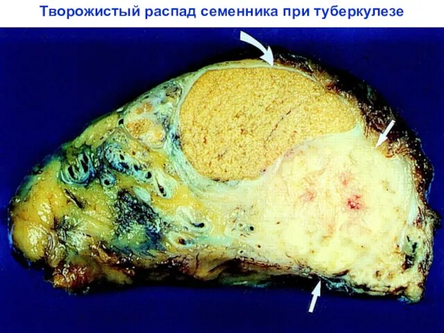 Творожистый распад семенника при туберкулезе