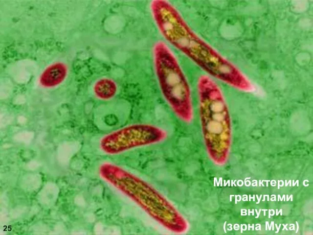 25 Микобактерии с гранулами внутри (зерна Муха)