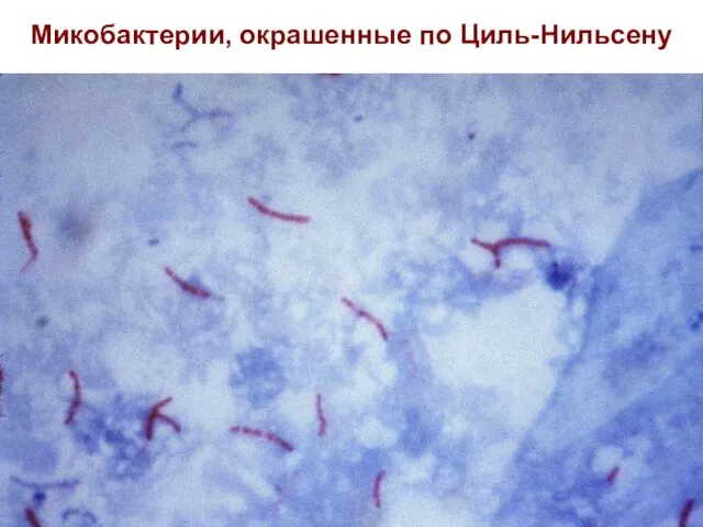 Микобактерии, окрашенные по Циль-Нильсену