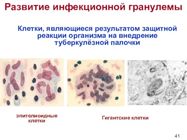 Развитие инфекционной гранулемы Клетки, являющиеся результатом защитной реакции организма на внедрение