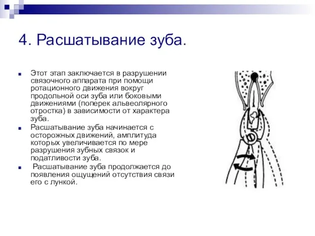 4. Расшатывание зуба. Этот этап заключается в разрушении связочного аппарата при