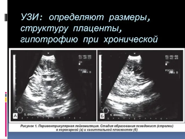 УЗИ: определяют размеры, структуру плаценты, гипотрофию при хронической гипоксии