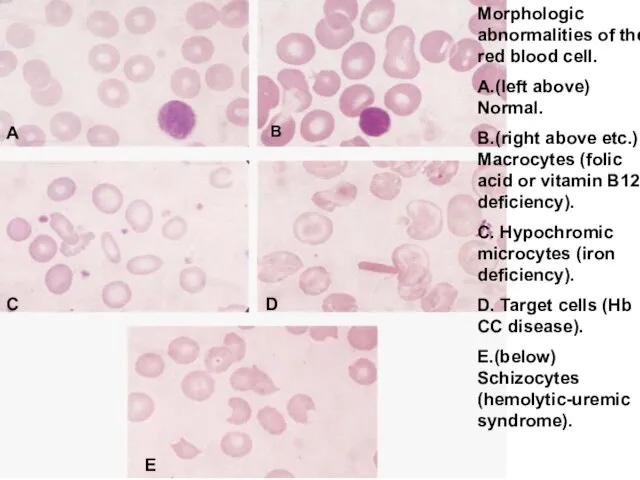 Morphologic abnormalities of the red blood cell. A.(left above) Normal. B.(right