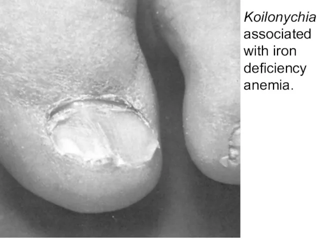 Koilonychia associated with iron deficiency anemia.