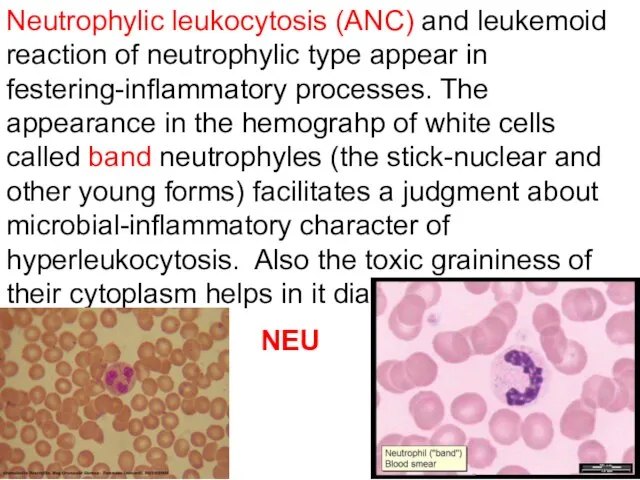 Neutrophylic leukocytosis (ANC) and leukemoid reaction of neutrophylic type appear in
