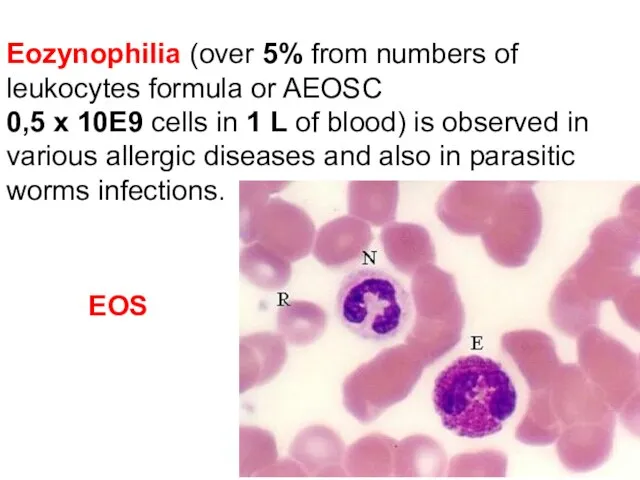 Eozynophilia (over 5% from numbers of leukocytes formula or AEOSC 0,5