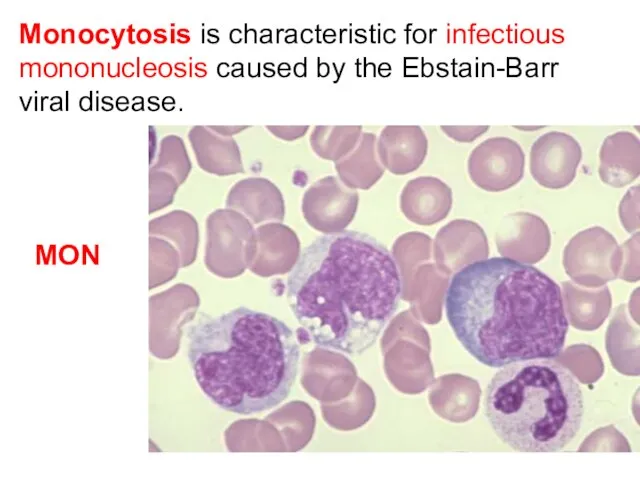 Monocytosis is characteristic for infectious mononucleosis caused by the Ebstain-Barr viral disease. MON