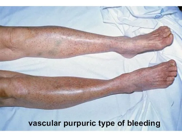 vascular purpuric type of bleeding