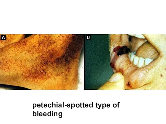 petechial-spotted type of bleeding