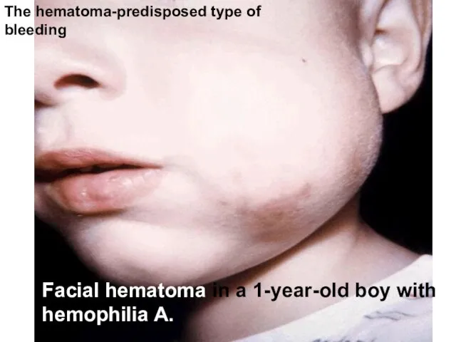 Facial hematoma in a 1-year-old boy with hemophilia A. The hematoma-predisposed type of bleeding