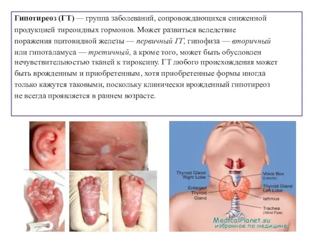 Гипотиреоз (ГТ) — группа заболеваний, сопровождающихся сниженной продукцией тиреоидных гормонов. Может