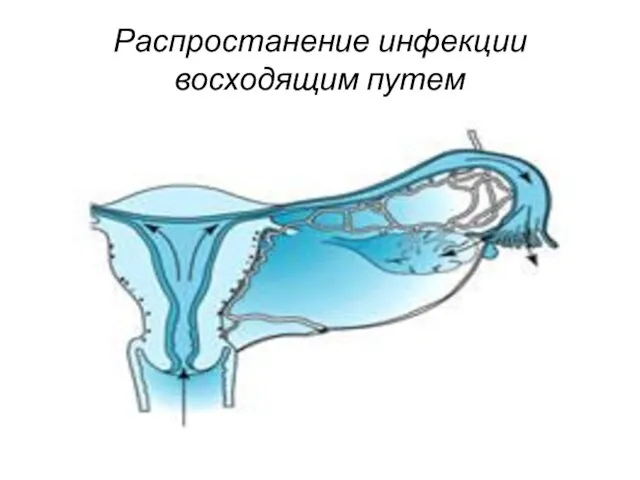 Распростанение инфекции восходящим путем