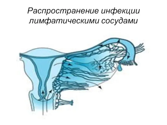 Распространение инфекции лимфатическими сосудами