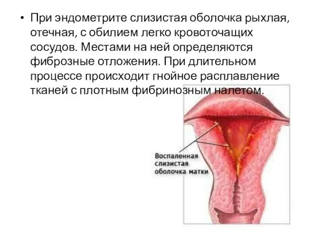 При эндометрите слизистая оболочка рыхлая, отечная, с обилием легко кровоточащих сосудов.