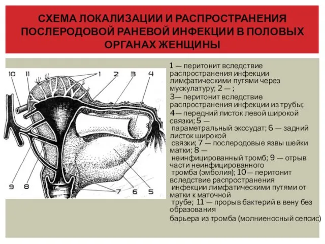 1 — перитонит вследствие распространения инфекции лимфатическими путями через мускулатуру; 2