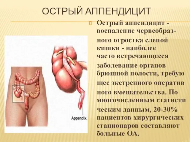 ОСТРЫЙ АППЕНДИЦИТ Острый аппендицит - воспаление червеобраз- ного отростка слепой кишки