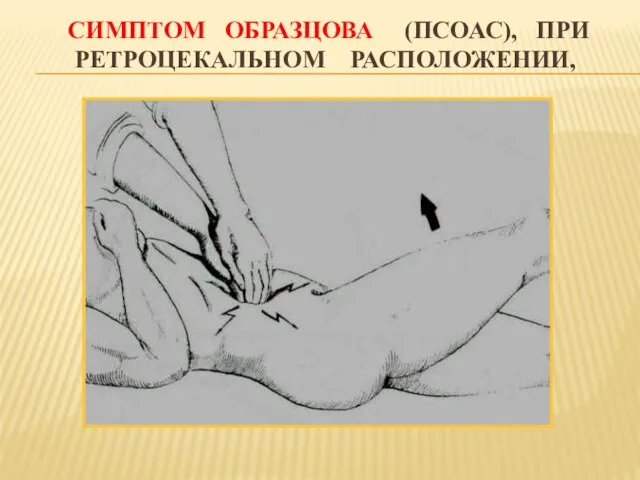 СИМПТОМ ОБРАЗЦОВА (ПСОАС), ПРИ РЕТРОЦЕКАЛЬНОМ РАСПОЛОЖЕНИИ,