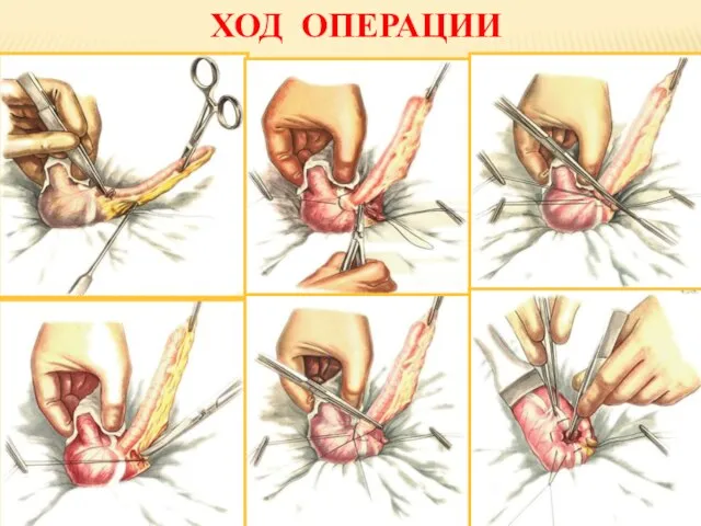 ХОД ОПЕРАЦИИ