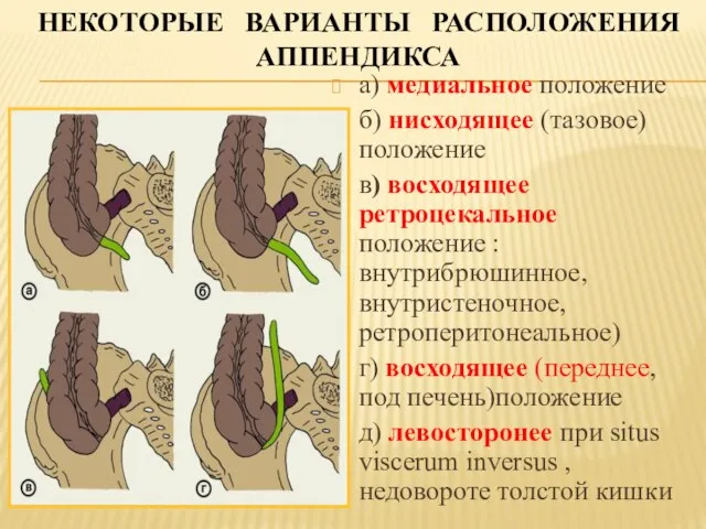 НЕКОТОРЫЕ ВАРИАНТЫ РАСПОЛОЖЕНИЯ АППЕНДИКСА а) медиальное положение б) нисходящее (тазовое) положение