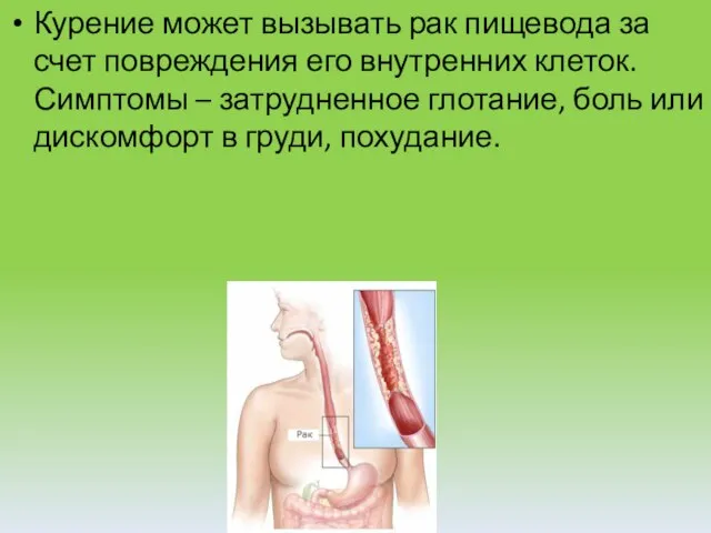 Курение может вызывать рак пищевода за счет повреждения его внутренних клеток.