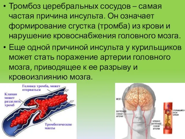 Тромбоз церебральных сосудов – самая частая причина инсульта. Он означает формирование