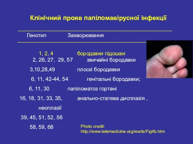 Генотип Захворювання 1, 2, 4 бородавки підошви 2, 26, 27, 29,