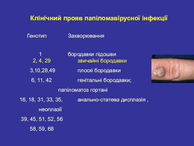 Клінічний прояв папіломавірусної інфекції Генотип Захворювання 1 бородавки підошви 2, 4,