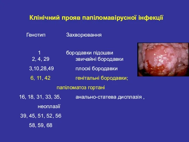 Клінічний прояв папіломавірусної інфекції Генотип Захворювання 1 бородавки підошви 2, 4,