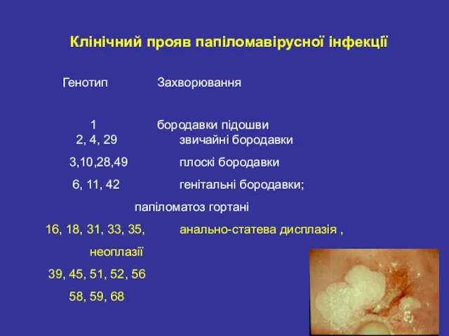 Клінічний прояв папіломавірусної інфекції Генотип Захворювання 1 бородавки підошви 2, 4,