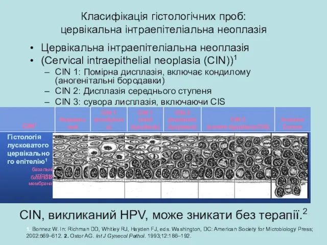 Класифікація гістологічних проб: цервікальна інтраепітеліальна неоплазія Цервікальна інтраепітеліальна неоплазія (Cervical intraepithelial