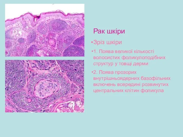 Рак шкіри Зріз шкіри 1. Поява великої кількості волосистих фоликулоподібних структур