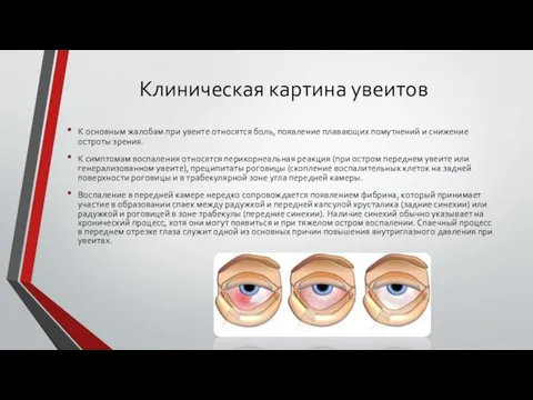 Клиническая картина увеитов К основным жалобам при увеите относятся боль, появление