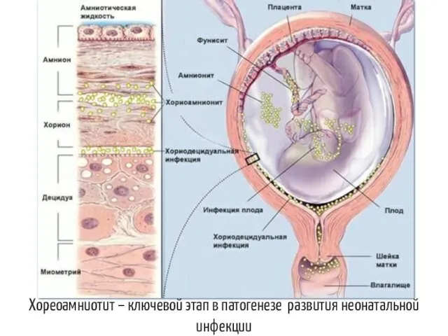 Хореоамниотит – ключевой этап в патогенезе развития неонатальной инфекции