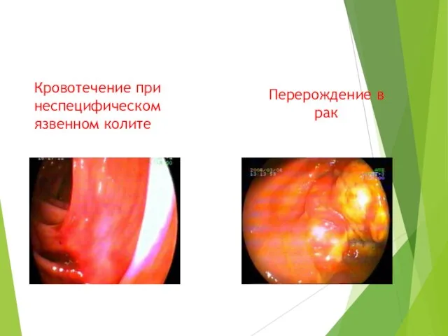 Кровотечение при неспецифическом язвенном колите Перерождение в рак