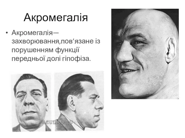 Акромегалія— захворювання,пов’язане із порушенням функції передньої долі гіпофіза. Акромегалія