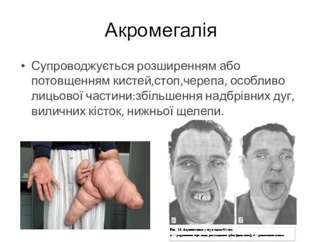 Супроводжується розширенням або потовщенням кистей,стоп,черепа, особливо лицьової частини:збільшення надбрівних дуг, виличних кісток, нижньої щелепи. Акромегалія