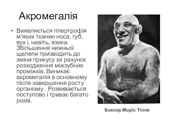 Виявляється гіпертрофія м’яких тканин носа, губ, вух і, навіть, язика. Збільшення