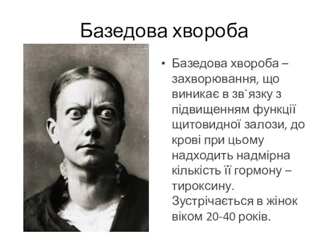 Базедова хвороба – захворювання, що виникає в зв`язку з підвищенням функції