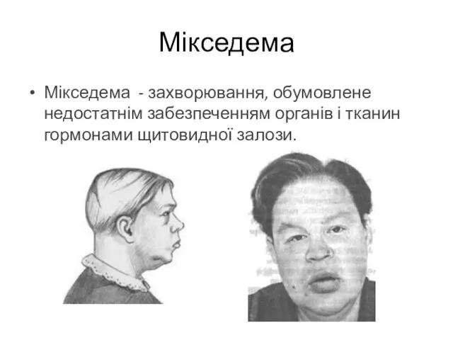 Мікседема - захворювання, обумовлене недостатнім забезпеченням органів і тканин гормонами щитовидної залози. Мікседема