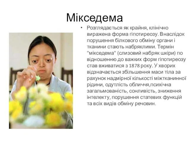 Розглядається як крайня, клінічно виражена форма гіпотиреозу. Внаслідок порушення білкового обміну