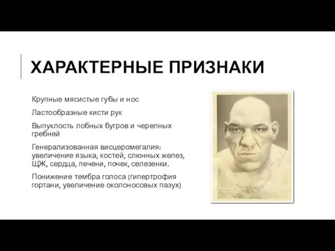 ХАРАКТЕРНЫЕ ПРИЗНАКИ Крупные мясистые губы и нос Ластообразные кисти рук Выпуклость