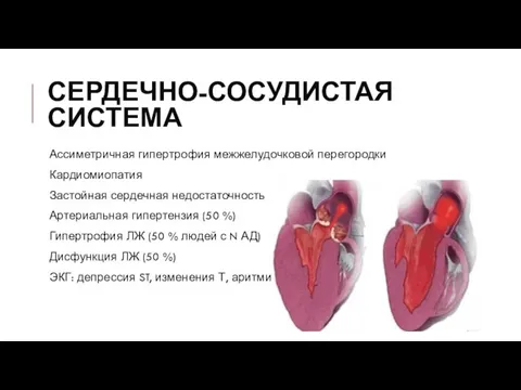 СЕРДЕЧНО-СОСУДИСТАЯ СИСТЕМА Ассиметричная гипертрофия межжелудочковой перегородки Кардиомиопатия Застойная сердечная недостаточность Артериальная