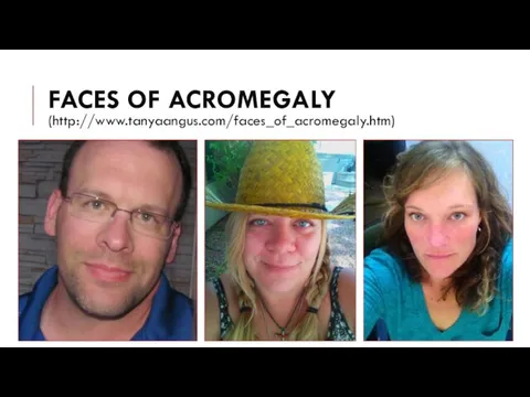 FACES OF ACROMEGALY (http://www.tanyaangus.com/faces_of_acromegaly.htm)