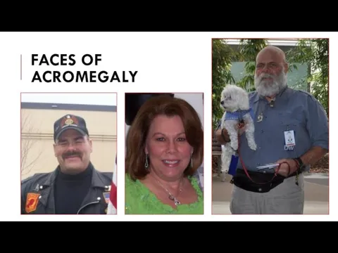 FACES OF ACROMEGALY