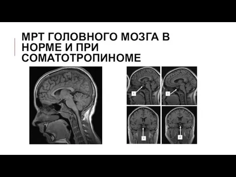 МРТ ГОЛОВНОГО МОЗГА В НОРМЕ И ПРИ СОМАТОТРОПИНОМЕ